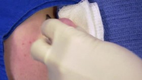 Dr Pimple Popper S05E10 A Spoonful of Cyst XviD-AFG EZTV