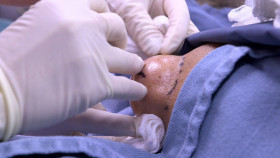 Dr  Pimple Popper 2018 S01E04 1080p AMZN WEB-DL H265 SDR DDP 2 0 English-HONE EZTV