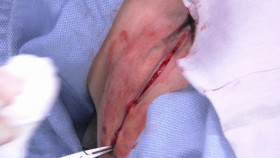 Dr  Pimple Popper 2018 S01E05 1080p AMZN WEB-DL H265 SDR DDP 2 0 English-HONE EZTV