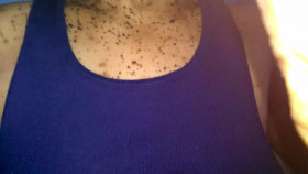 Dr  Pimple Popper 2018 S02E02 1080p AMZN WEB-DL H265 SDR DDP 2 0 English-HONE EZTV