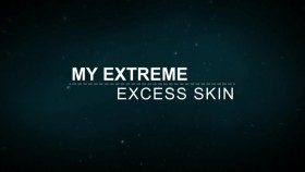 My Extreme Excess Skin S02E04 720p WEB H264-GIMINI EZTV