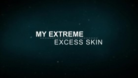 My Extreme Excess Skin S02E04 WEB H264-GIMINI EZTV