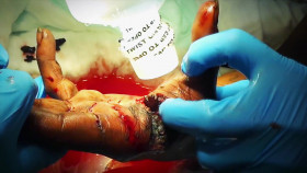 This Came Out of Me S01E01 Swollen Infected Impaled 1080p WEB h264-B2B EZTV